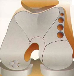 Picture of osteoarticular transfer system
