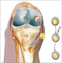 Picture of autologous chondrocyte implantation