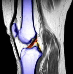 Picture of acl in knee