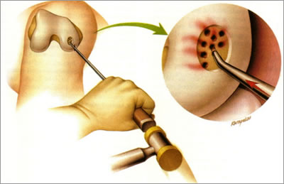 Picture of microfracture