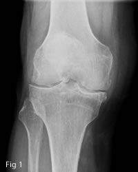 osteoarthritis of the knee