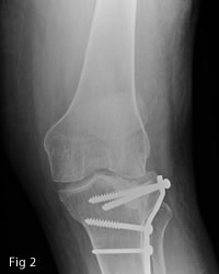 osteoarthritis following a fracture