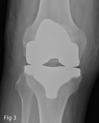 osteoarthritis total knee replacement