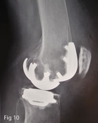 Partial knee replacement