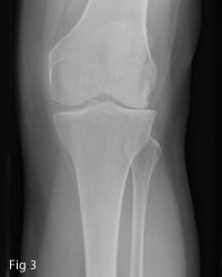 Lateral compartment OA