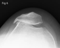 Patellofemoral OA