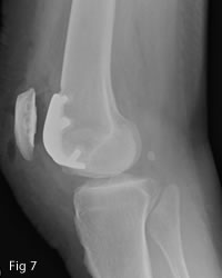 Patellofemoral replacement