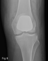 Patellofemoral replacement