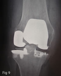 Partial knee replacement