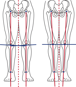 Shapematched total knee replacement