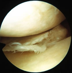 Picture of torn and worn Meniscus