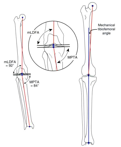 Traditional knee replacement